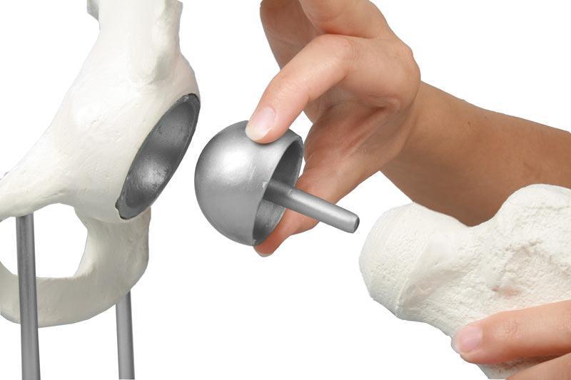 Hüftgelenk mit Schalenprothese, 1118 - Notemed Medizintechnik