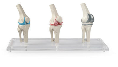 Knie-Implantat-Modell, 1125 - Notemed Medizintechnik