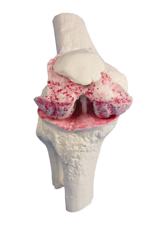 Knie-Implantat-Modell, 1125 - Notemed Medizintechnik