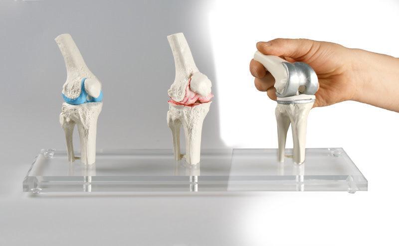 Knie-Implantat-Modell, 1125 - Notemed Medizintechnik