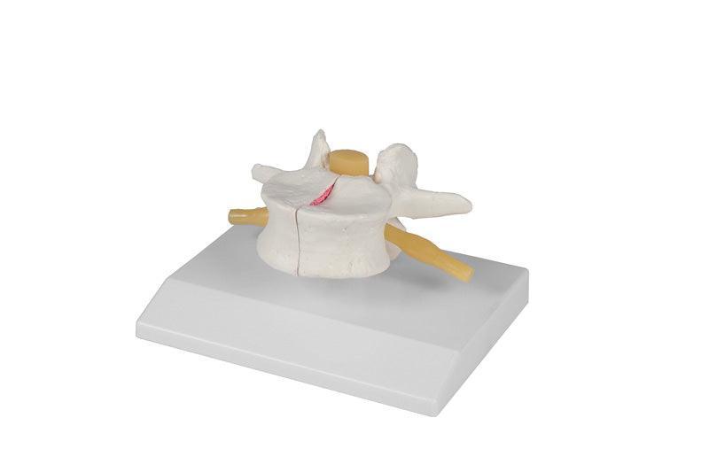 Osteoporose-Wirbel, 2-fach vergrößert, 4068 - Notemed Medizintechnik 