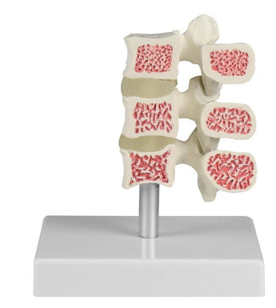 Osteoporose-Wirbel-Modell, 3 Wirbel, 4078 - Notemed Medizintechnik 
