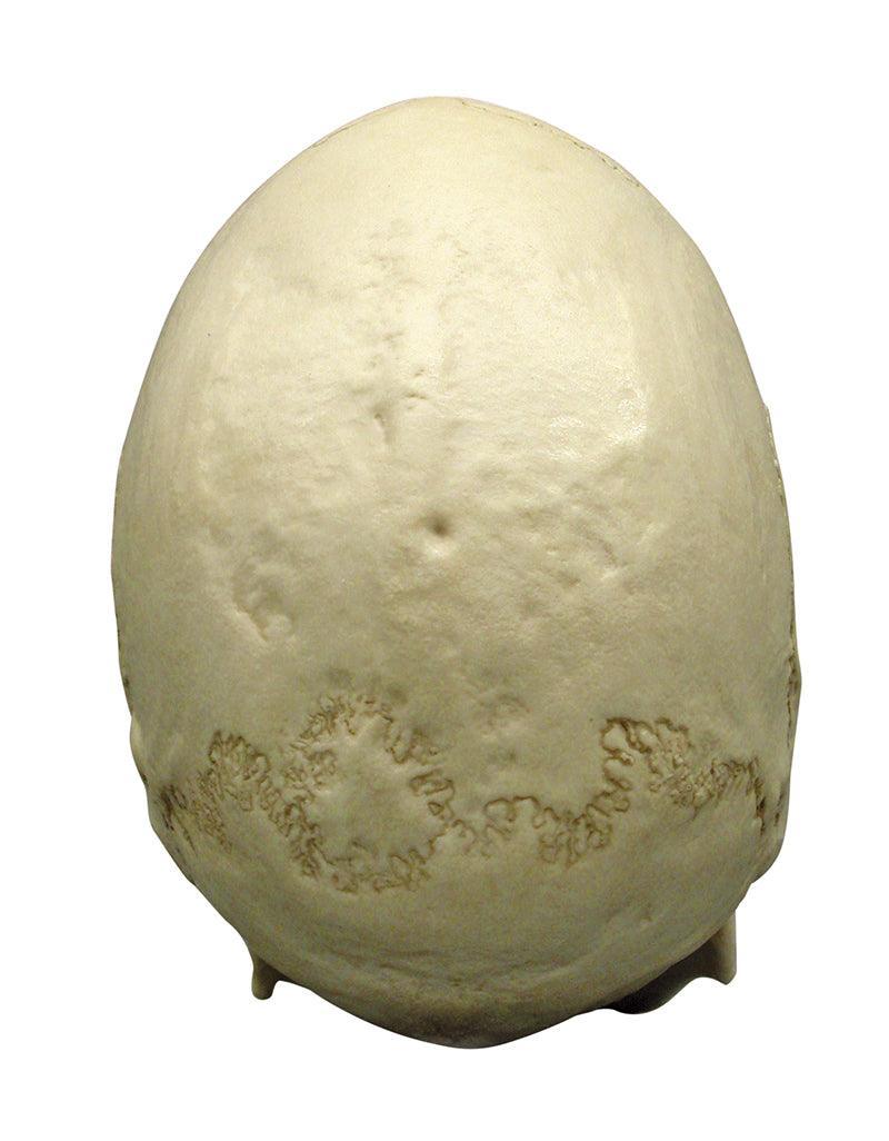 Skaphozephaler Schädel, 4778 - Notemed Medizintechnik 