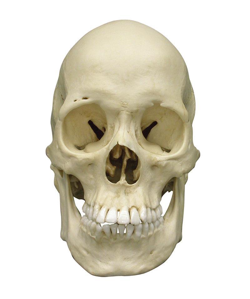Skaphozephaler Schädel, 4778 - Notemed Medizintechnik 