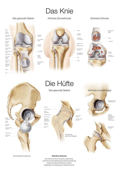 Lehrtafel Das Knie / Die Hüfte, 50x70cm, AL551 - Notemed Medizintechnik 