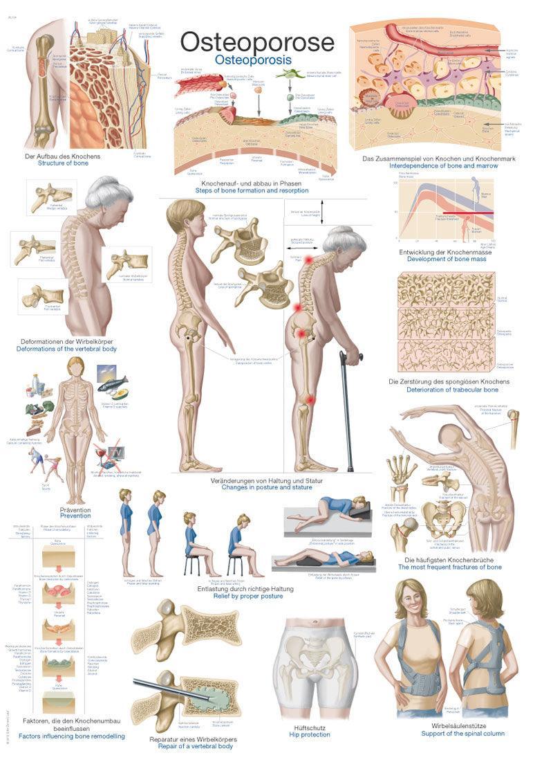 Lehrtafel Osteoporose, 50x70cm, AL504 - Notemed Medizintechnik 