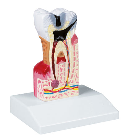 Zahnkariesmodell, 10-fache Größe, D214 Erler-Zimmer