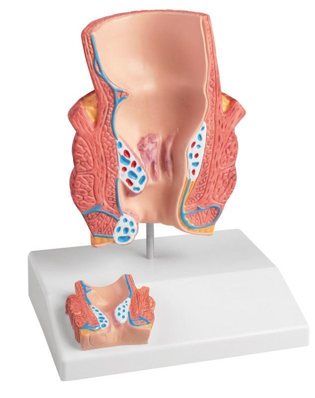 Hämorrhoidenmodell, 2-fache Größe, K227 - Notemed Medizintechnik 