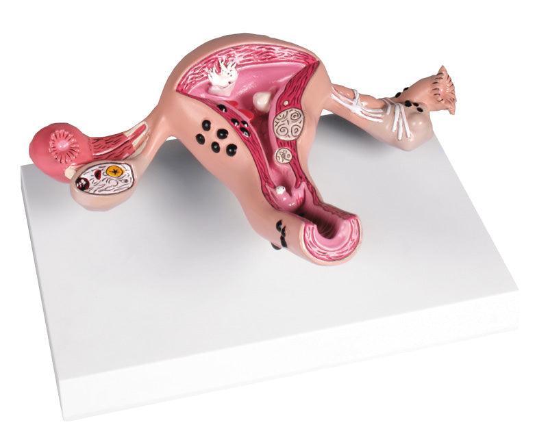 Uterusmodell mit Erkrankungen, L262 - Notemed Medizintechnik 