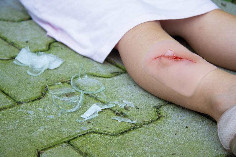 Wundmoulage Schnittwunde mit Glassplitter, NW001 - Notemed Medizintechnik 