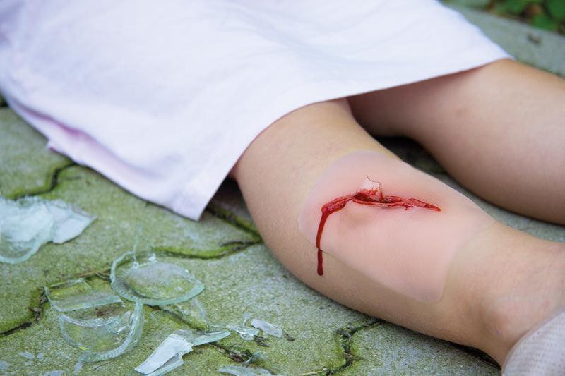 Wundmoulage Schnittwunde mit Glassplitter, NW001 - Notemed Medizintechnik 