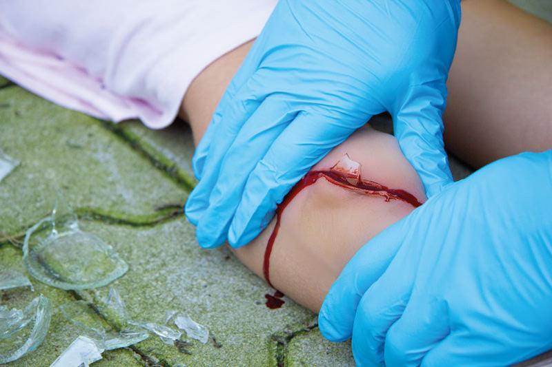 Wundmoulage Schnittwunde mit Glassplitter, NW001 - Notemed Medizintechnik 