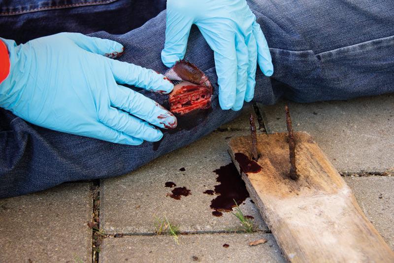 Wundmoulage Schnittwunde, NW002 - Notemed Medizintechnik 
