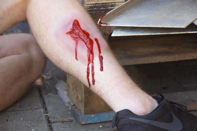 Wundmoulage Risswunde, NW003 - Notemed Medizintechnik 