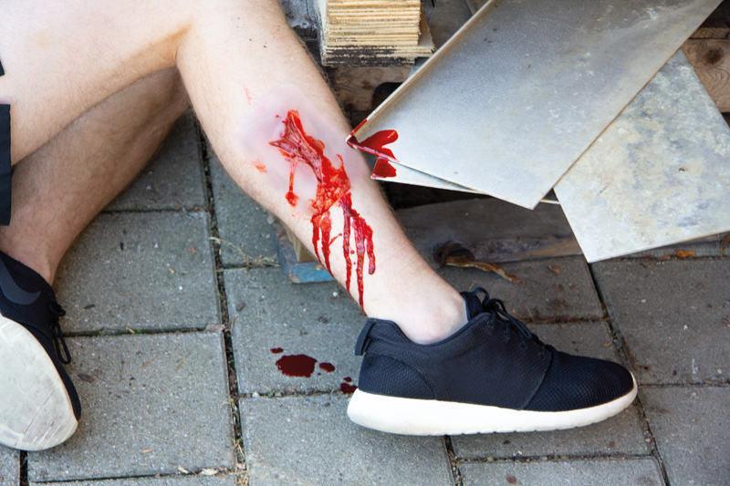 Wundmoulage Risswunde, NW003 - Notemed Medizintechnik 