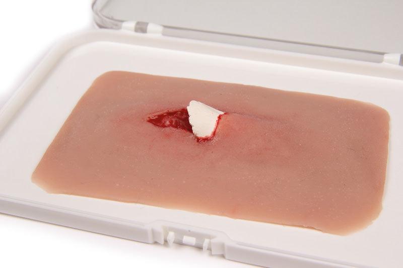 Wundmoulage offener Knochenbruch, NW004 - Notemed Medizintechnik 