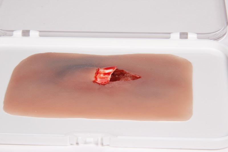 Wundmoulage offener Knochenbruch, NW004 - Notemed Medizintechnik 