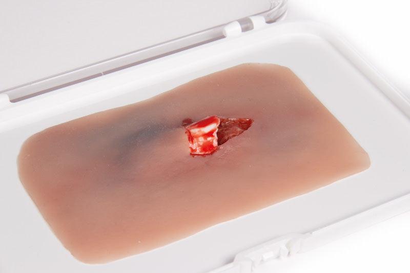 Wundmoulage offener Knochenbruch, NW004 - Notemed Medizintechnik 