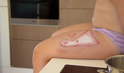 Wundmoulage Verbrühung, NW011 - Notemed Medizintechnik 