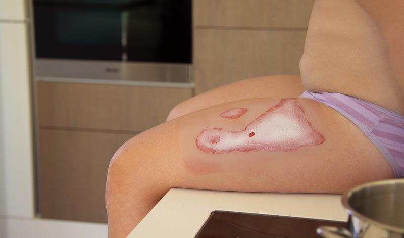 Wundmoulage Verbrühung, NW011 - Notemed Medizintechnik 