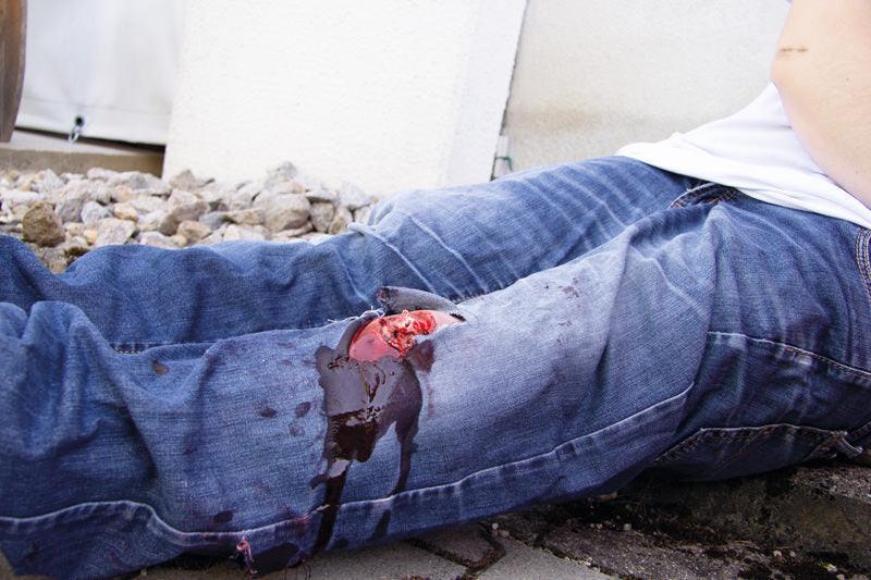 Offener Bruch Bein mit Blutungsfunktion, NW103 - Notemed Medizintechnik 