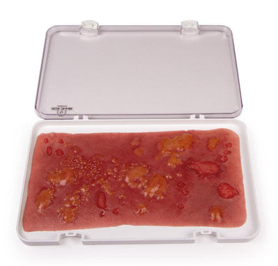 Wundmoulage Verbrennung II. Grades, NW106 - Notemed Medizintechnik 