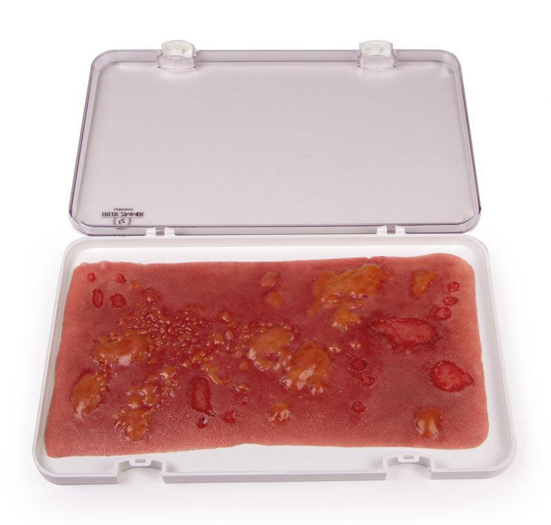 Wundmoulage Verbrennung II. Grades, NW106 - Notemed Medizintechnik 