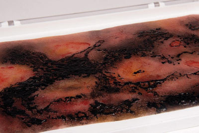 Wundmoulage Verbrennung III. Grades, NW107 - Notemed Medizintechnik 