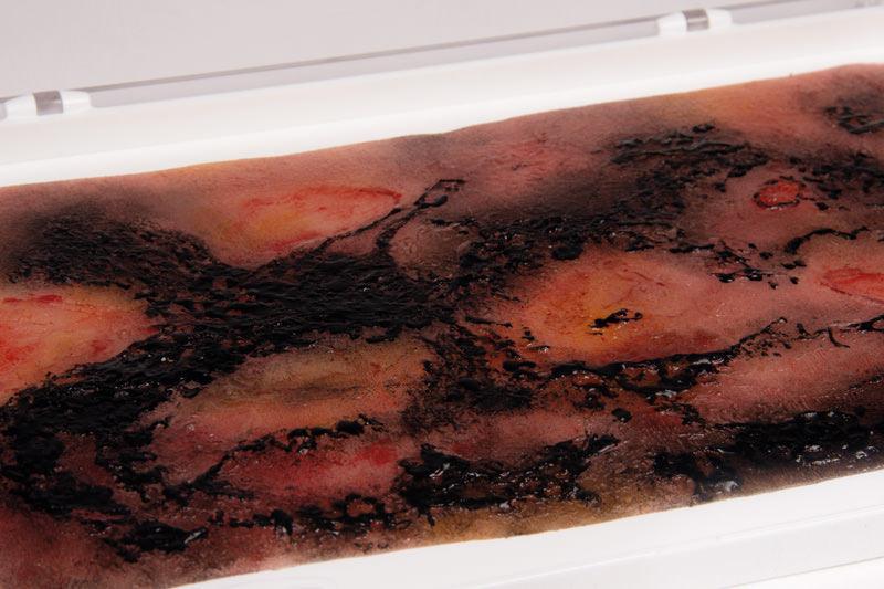 Wundmoulage Verbrennung III. Grades, NW107 - Notemed Medizintechnik 