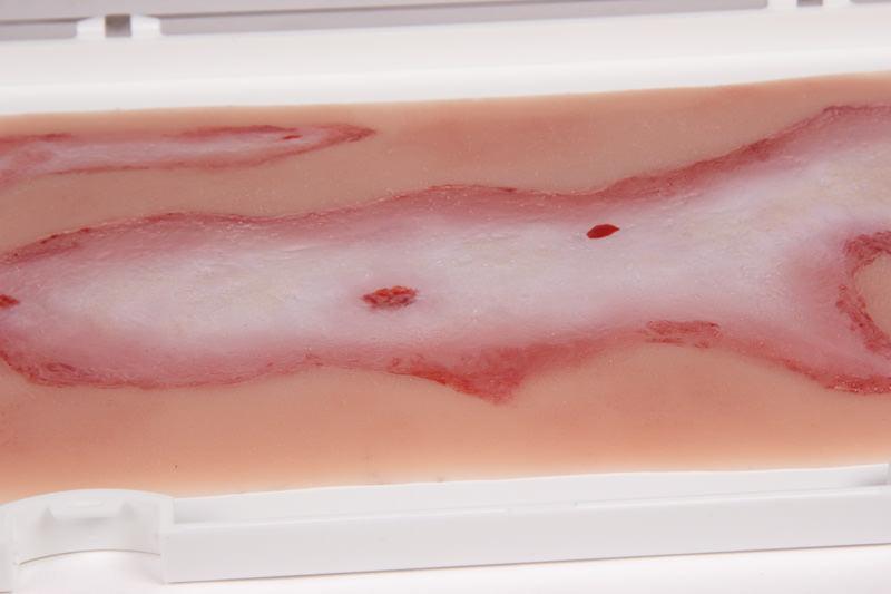 Wundmoulage Verbrühung, NW108 - Notemed Medizintechnik 