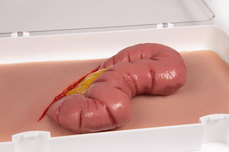Wundmoulage Dickdarmaustritt, NW109 - Notemed Medizintechnik 