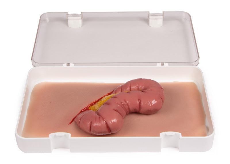 Wundmoulage Dickdarmaustritt, NW109 - Notemed Medizintechnik 