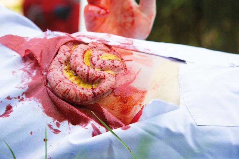 Wundmoulage Dünndarmaustritt, NW111 - Notemed Medizintechnik 
