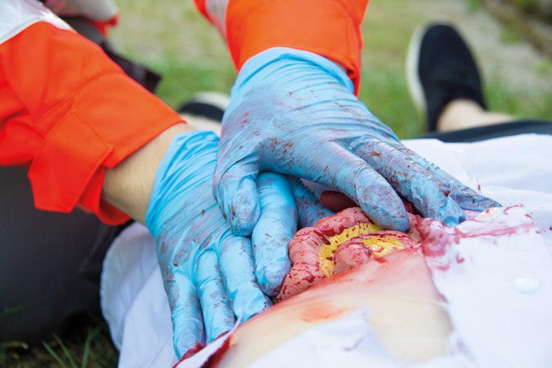 Wundmoulage Dünndarmaustritt, NW111 - Notemed Medizintechnik 