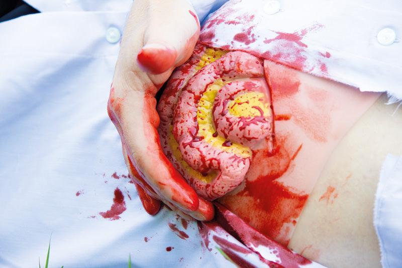 Wundmoulage Dünndarmaustritt, NW111 - Notemed Medizintechnik 