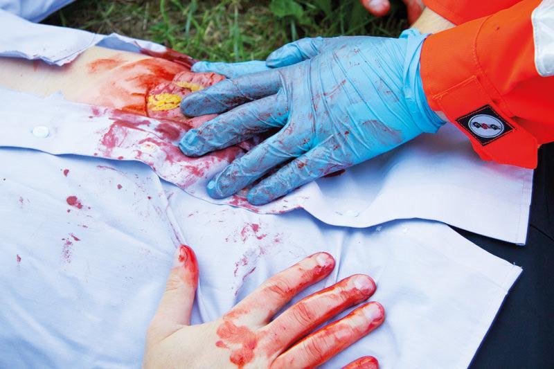 Wundmoulage Dünndarmaustritt, NW111 - Notemed Medizintechnik 