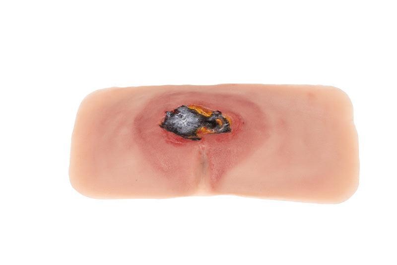 Wundmoulage sakraler Dekubitus, unbehandelt, PW001A - Notemed Medizintechnik 