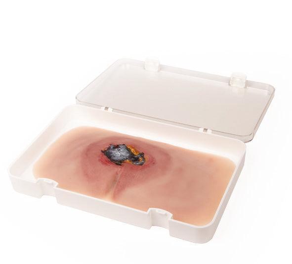 Wundmoulage sakraler Dekubitus, unbehandelt, PW001A - Notemed Medizintechnik 