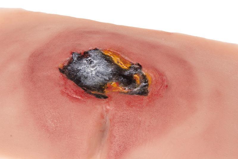 Wundmoulage sakraler Dekubitus, unbehandelt, PW001A - Notemed Medizintechnik 