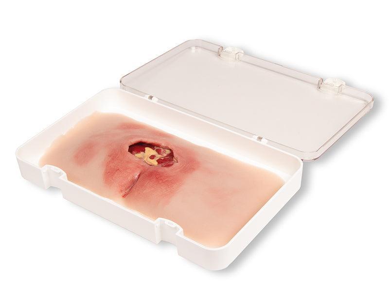 Wundmoulage sakraler Dekubitus, gesäubert, PW001B - Notemed Medizintechnik 