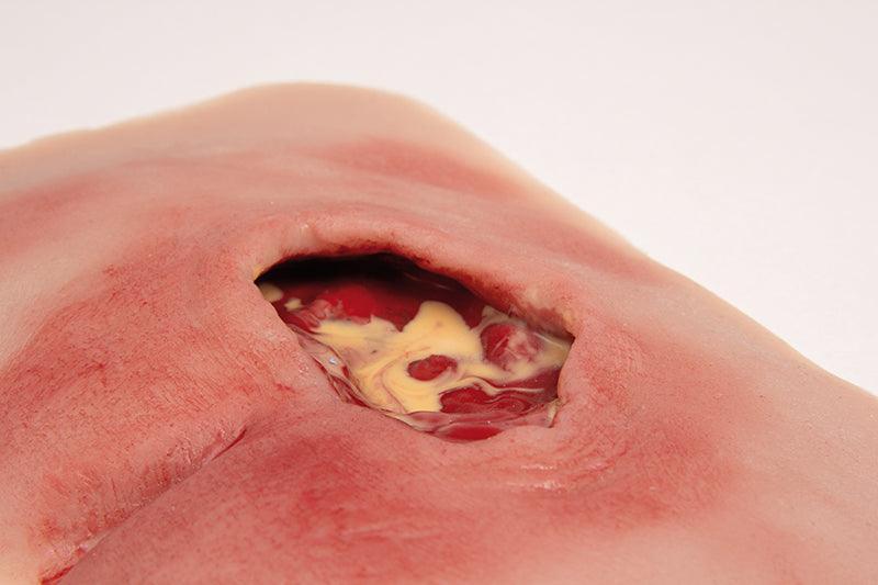 Wundmoulage sakraler Dekubitus, gesäubert, PW001B - Notemed Medizintechnik 