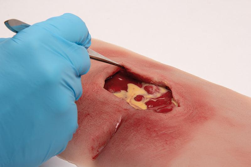 Wundmoulage sakraler Dekubitus, gesäubert, PW001B - Notemed Medizintechnik 