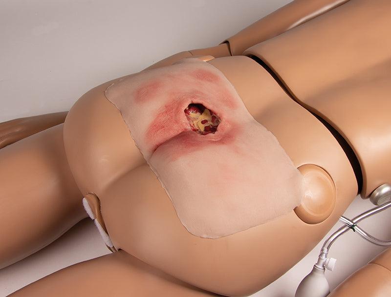 Wundmoulage sakraler Dekubitus, gesäubert, PW001B - Notemed Medizintechnik 