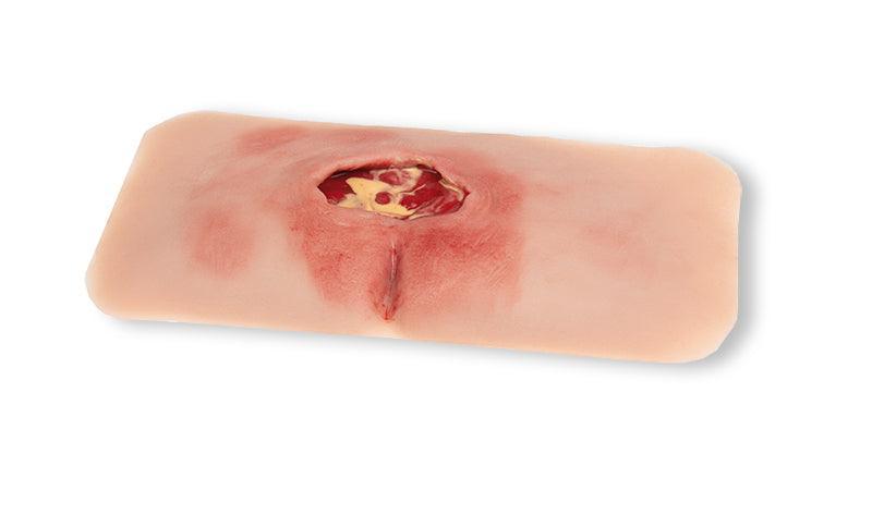 Wundmoulage sakraler Dekubitus, gesäubert, PW001B - Notemed Medizintechnik 