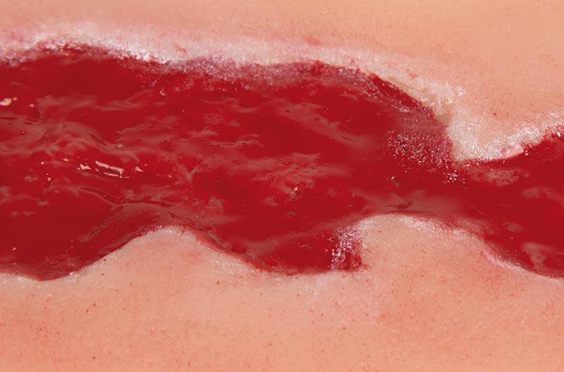 Wundmoulage Ulcus Cruris Venosum, klein, Granulationsphase, PW002B - Notemed Medizintechnik 