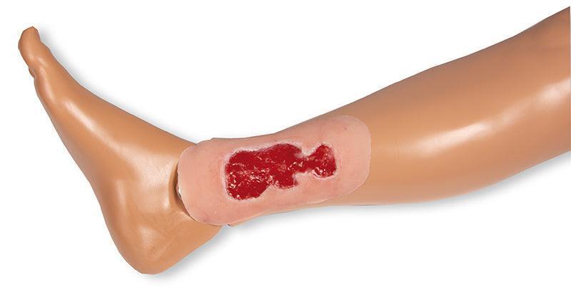 Wundmoulage Ulcus Cruris Venosum, klein, Granulationsphase, PW002B - Notemed Medizintechnik 