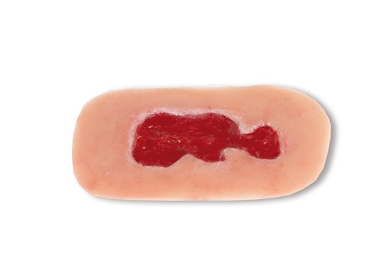 Wundmoulage Ulcus Cruris Venosum, klein, Granulationsphase, PW002B - Notemed Medizintechnik 