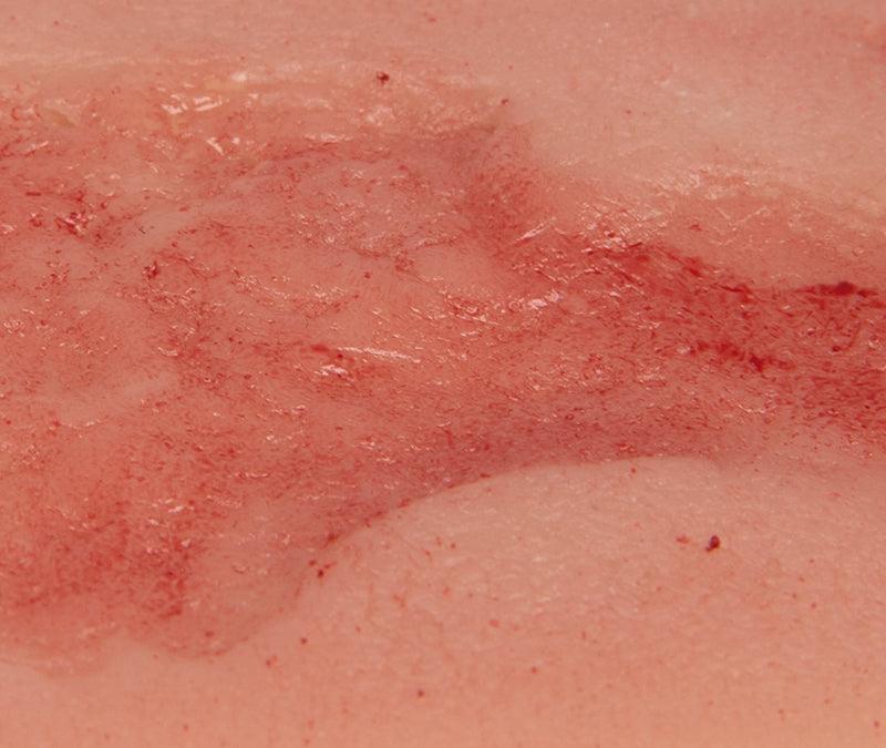 Wundmoulage Ulcus Cruris Venosum, klein, Epithelisierungsphase, PW002C - Notemed Medizintechnik 