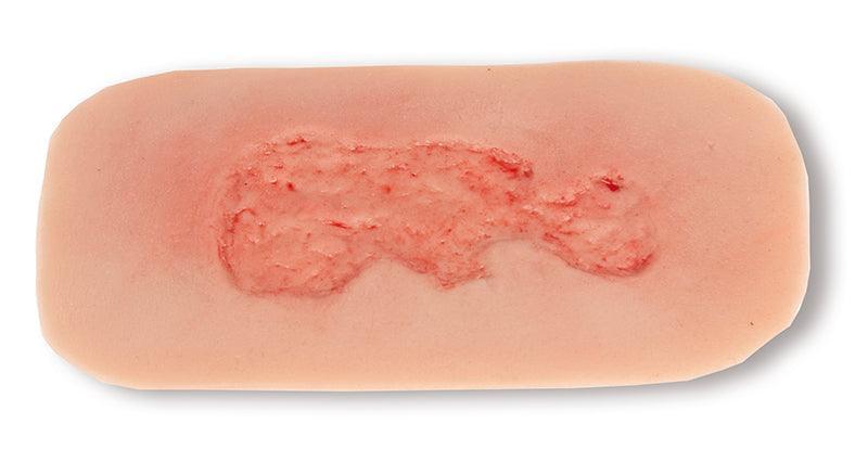 Wundmoulage Ulcus Cruris Venosum, klein, Epithelisierungsphase, PW002C - Notemed Medizintechnik 