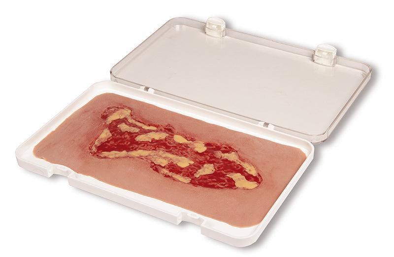 Wundmoulage Ulcus Cruris Venosum, groß, Exsudationsphase, PW003A - Notemed Medizintechnik 